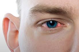 علت اصلی عفونتهای چشمی